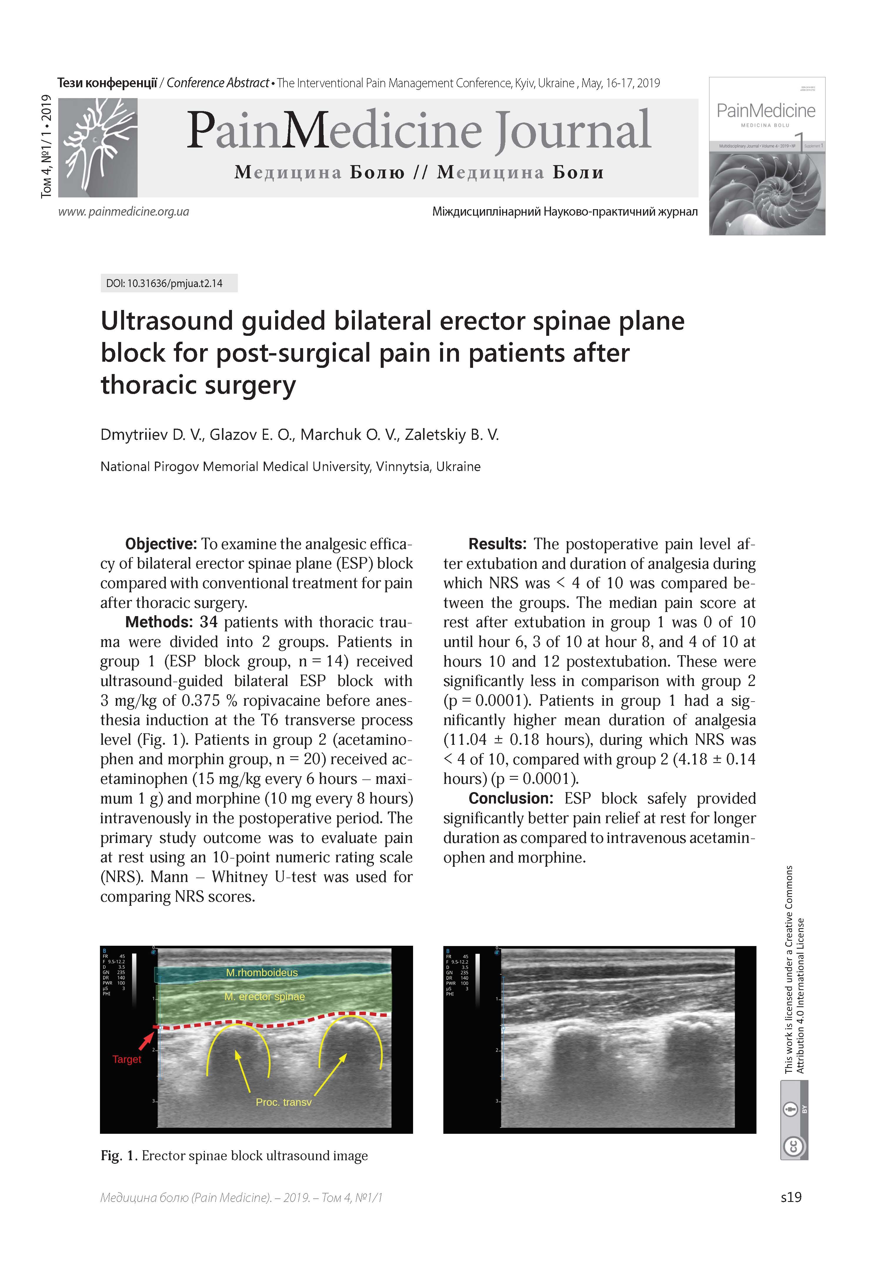 Ultrasound guided bilateral erector spinae plane block for post-surgical pain in patients after thoracic surgery